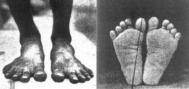 Normal-foot